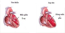 Dấu hiệu báo động nguy cơ suy tim bạn cần biết