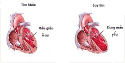 Dấu hiệu báo động nguy cơ suy tim bạn cần biết