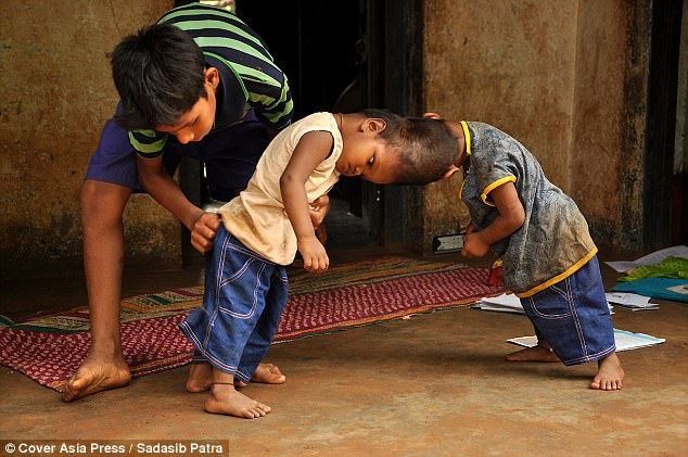chuyen la o an do hai anh em bi dinh lien dau