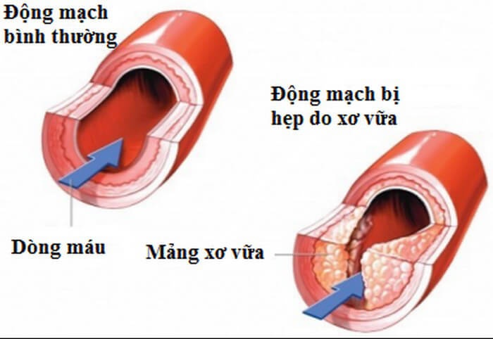 dau hieu canh bao benh thieu mau nao
