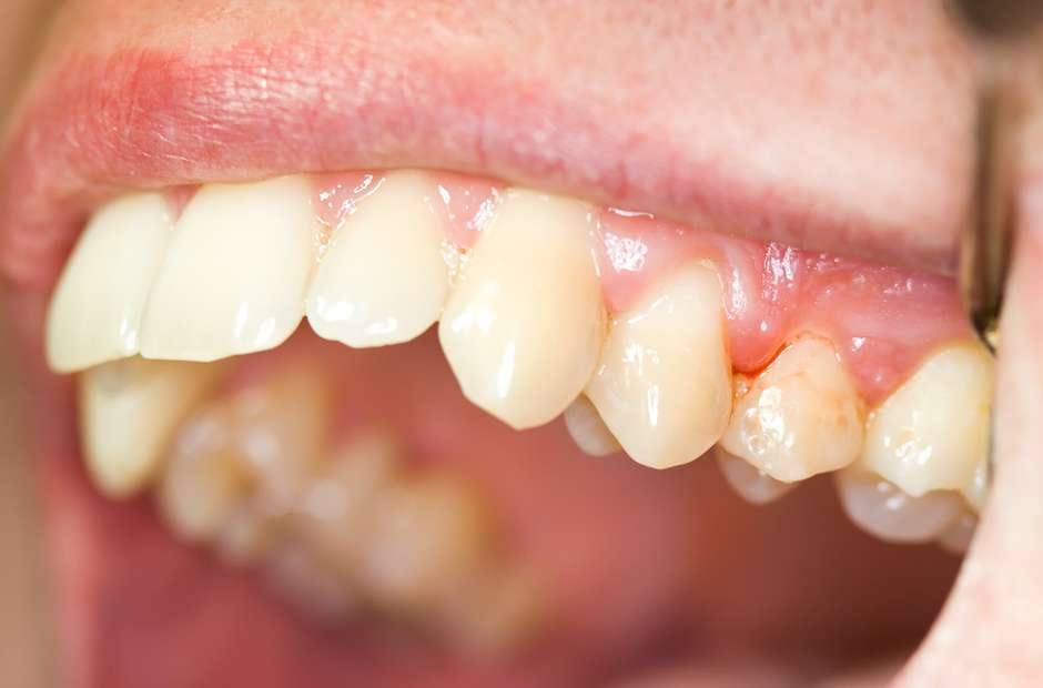 Những điều bạn cần chú ý về triệu chứng tăng đường huyết nhung dieu ban can chu y ve trieu chung tang duong huyet