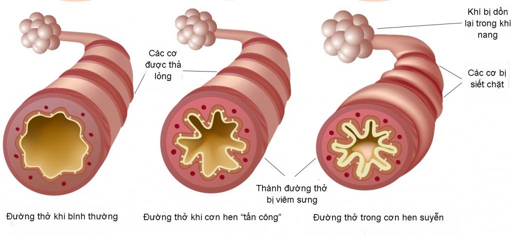 Hen phế quản, căn bệnh gây chết người chỉ đứng sau ung thư hen phe quan can benh gay chet nguoi chi dung sau ung thu