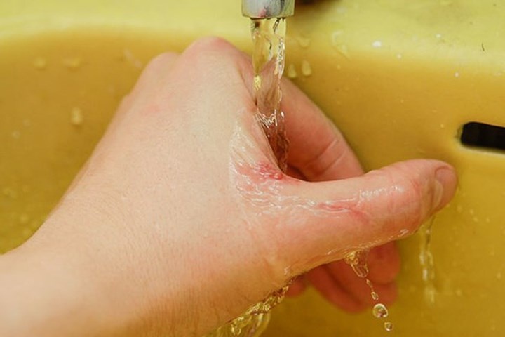 Cảnh báo: Bệnh dại có chiều hướng gia tăng, nhiều người tử vong vì chó cắn canh bao benh dai co chieu huong gia tang nhieu nguoi tu vong vi cho can