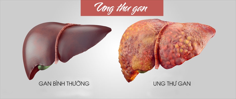 li do nao khien viet nam thuoc top 2 ban do ung thu the gioi