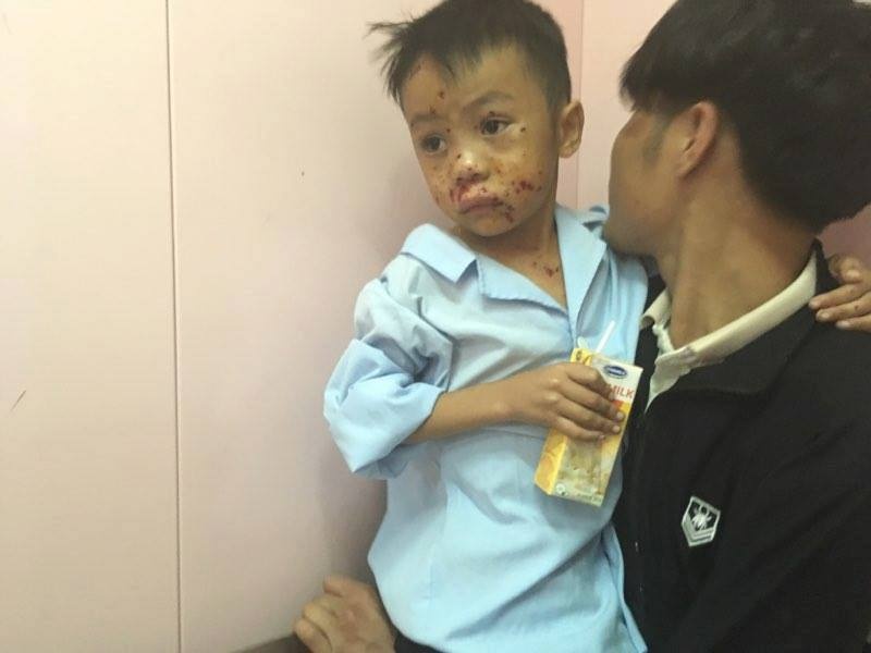 ha tinh vat the la phat no hai anh em cung nhap vien