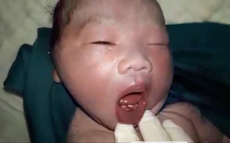 ha tinh hy huu be trai so sinh vua chao doi da moc rang cua