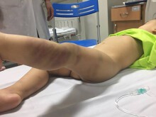 Cháu bé hơn 1 tuổi bị bạo hành chấn thương sọ não được xuất viện