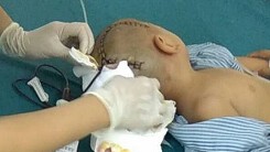 Bé trai 3 tuổi bị xuất huyết não, tụ máu 1/4 não, cô giáo nói 'do ngóng mẹ nên bị ngã'