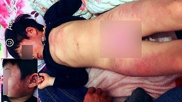 bac giang be gai 4 tuoi co nhieu vet bam tim sau khi di hoc ve