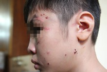 Những vết sẹo hằn trên người bé trai 10 tuổi bị bố đẻ và mẹ kế bạo hành