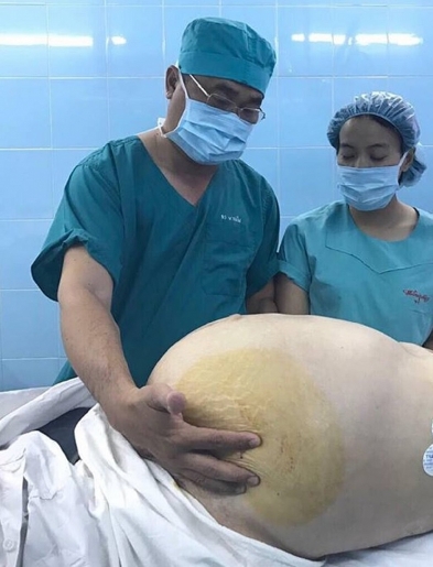 giai thoat ba cu 74 tuoi khoi khoi u nang 20kg