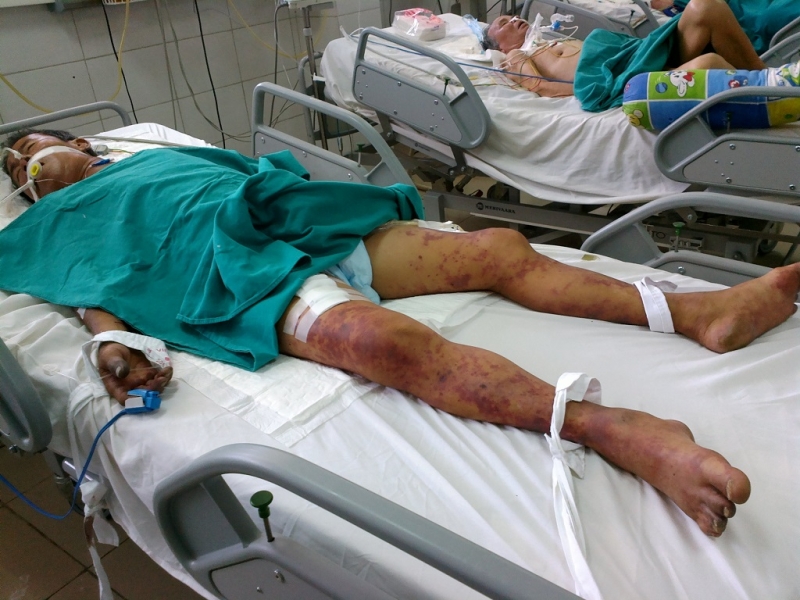 tp hcm so ca nhiem lien cau lon tang 300 so voi cung ky nam 2015