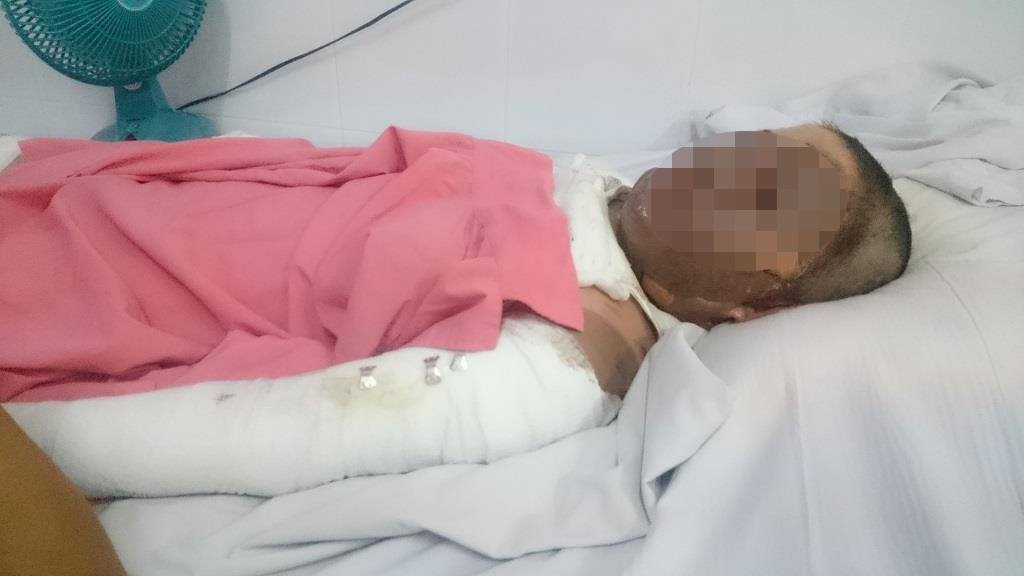 nau chao ngu quen mot phu nu bi bong ga nang