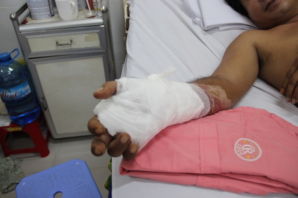 di cau bi dien giat khien hoai tu gan co tay