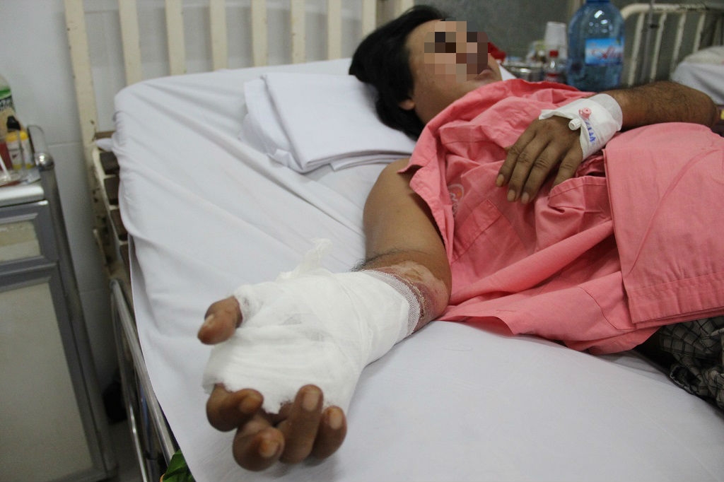 di cau bi dien giat khien hoai tu gan co tay