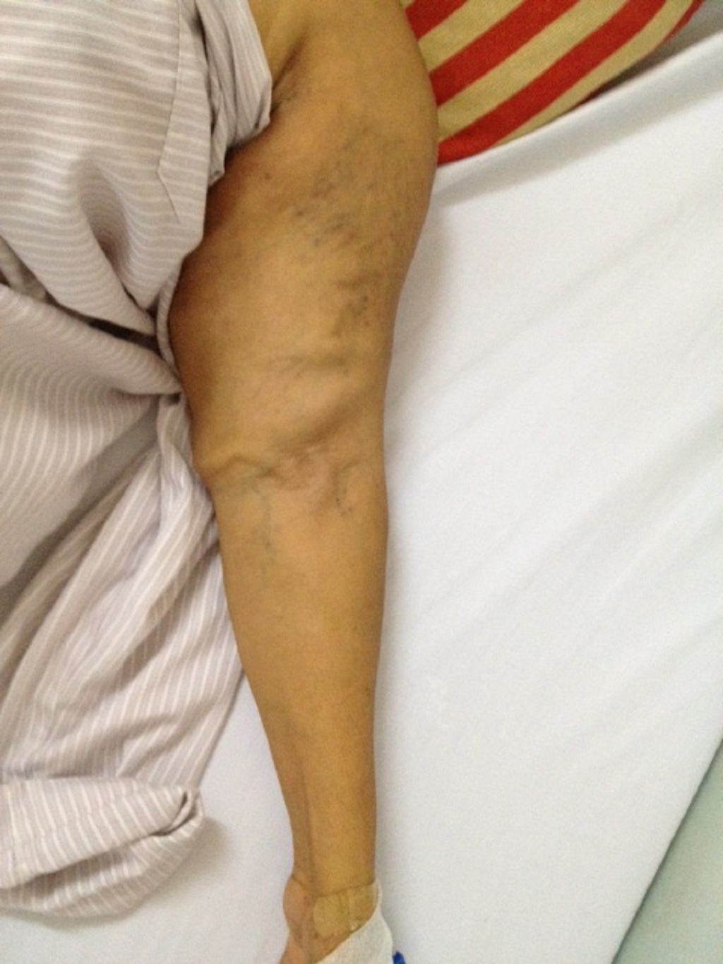 chua thanh cong canh tay bi bien dang sau 43 nam