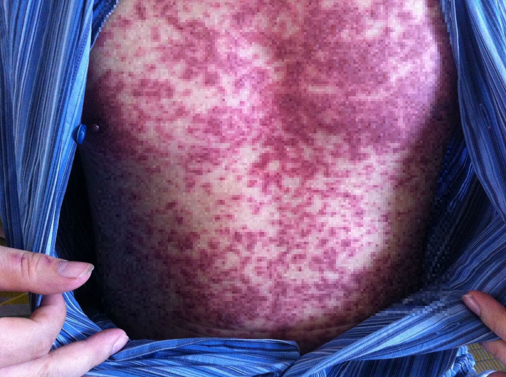 dung thuoc khang sinh dieu tri gout bua bai de bi hoai tu da