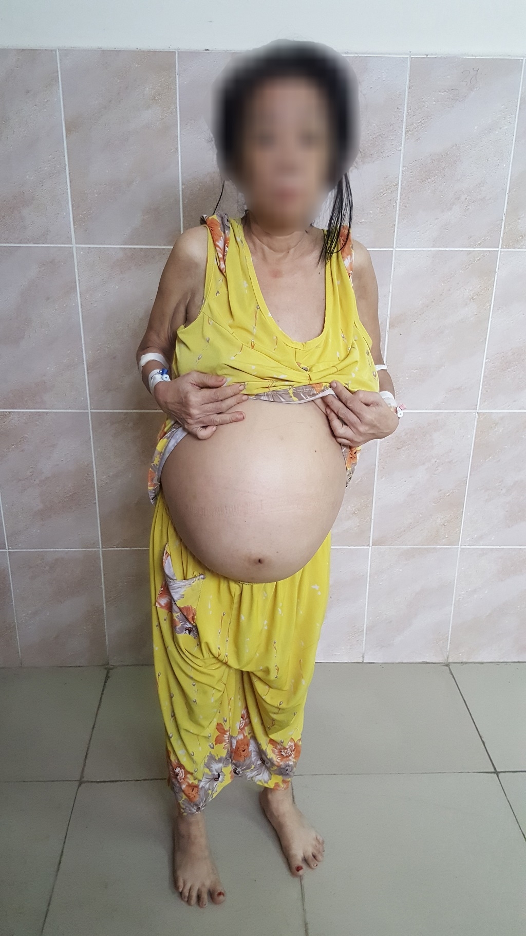 bung to nhieu nam mot phu nu khong ngo mang khoi u 12kg