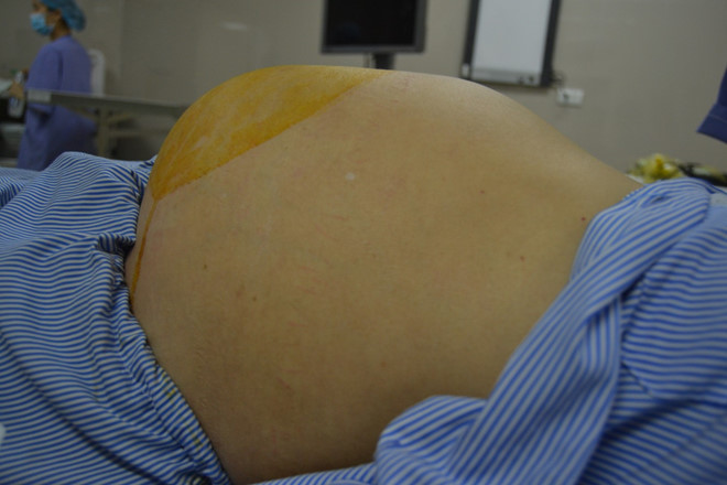 bung to nhu mang thai 8 thang vi khoi u nhay nang 6 kg