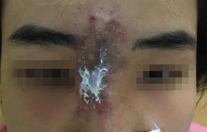 nu sinh 19 tuoi bi hoai tu da sau nang mui