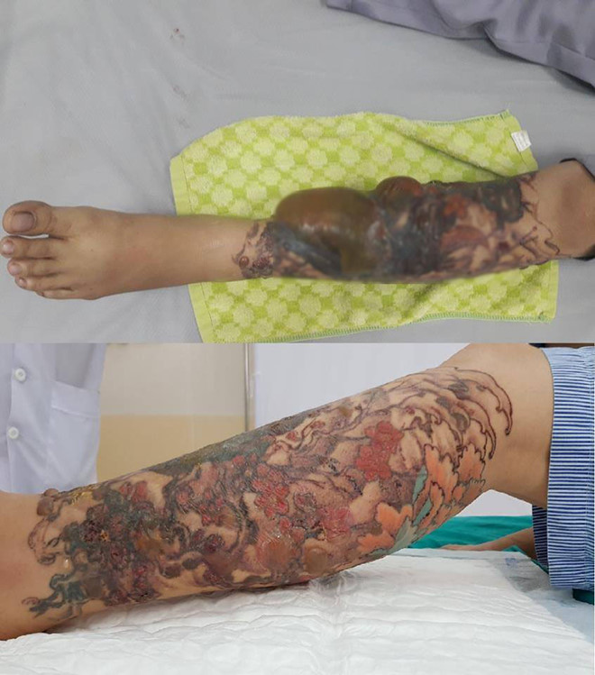 hoai tu chan vi xoa hinh xam bang laser