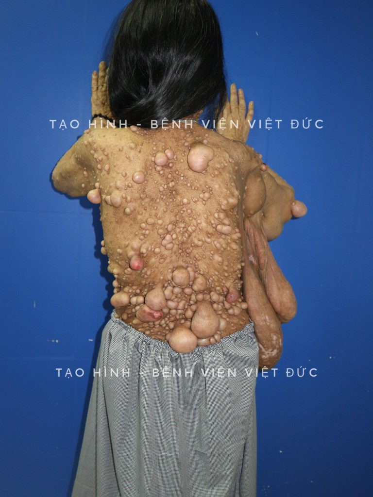 kinh hoang nguoi phu nu moc u toan than chi chit nhu qua sung