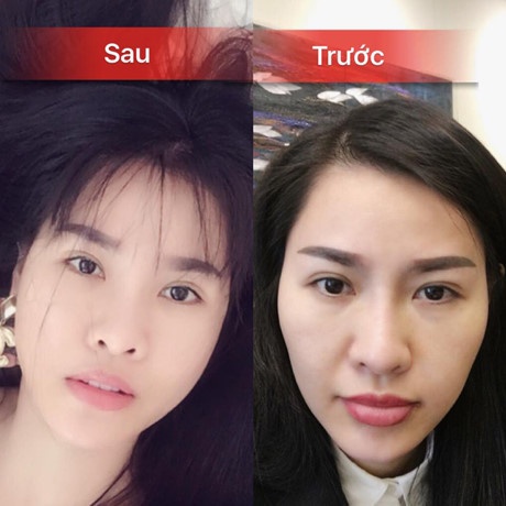chang rieng duc phuc nhieu sao viet sau phau thuat tham my cung lot xac ngo ngang