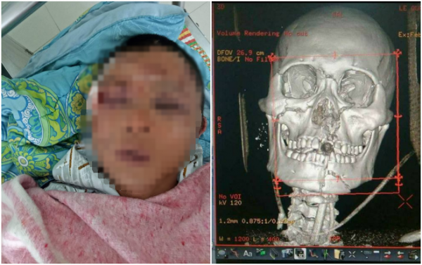nguoi dan ong nghi bat coc be gai 14 tuoi bi danh oan den muc da chan thuong rat nang