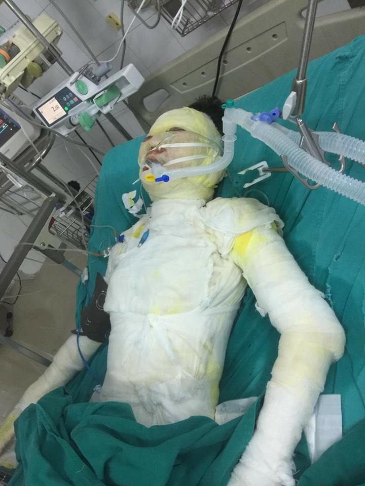 thieu nu bi ban trai tam xang dot o vinh phuc bong 92 co the nan nhan co tien luong xau