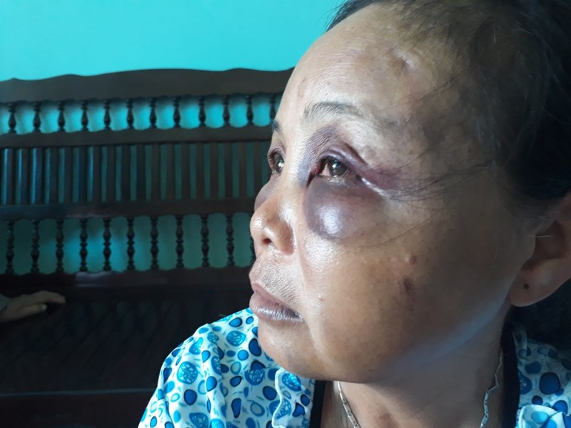 2 phu nu bi danh vi nghi bat coc ho qua hung han