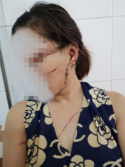 rach mat cat gan chan vo sau chuyen xuat khau lao dong