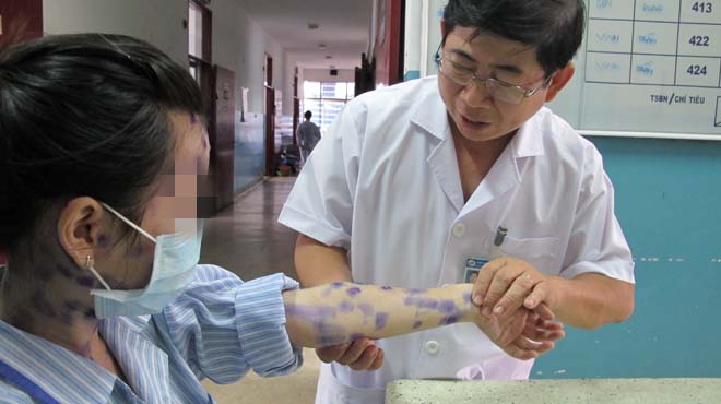 Vì sao bệnh thủy đậu lành tính nhưng có thể biến chứng chết người? vi sao benh thuy dau lanh tinh nhung co the bien chung chet nguoi