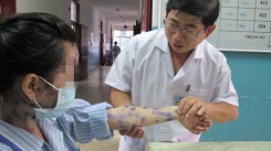 Vì sao bệnh thủy đậu lành tính nhưng có thể biến chứng chết người?