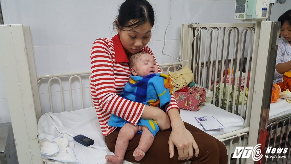 Vì sao bệnh thủy đậu lành tính nhưng có thể biến chứng chết người? vi sao benh thuy dau lanh tinh nhung co the bien chung chet nguoi