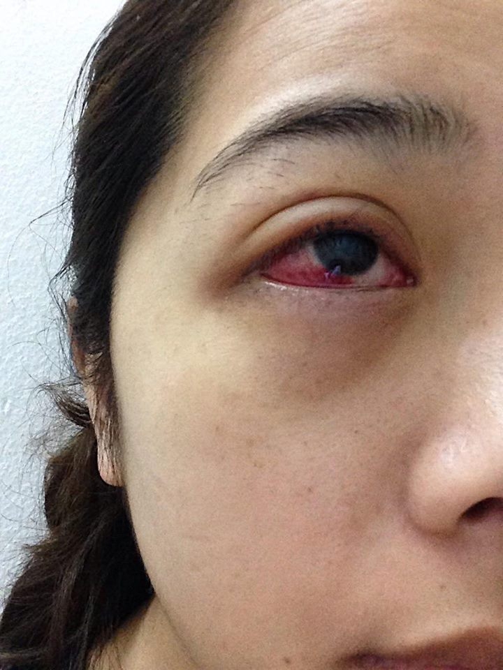 co gai tre bi mau tu trong mat sau 2 tuan noi mi