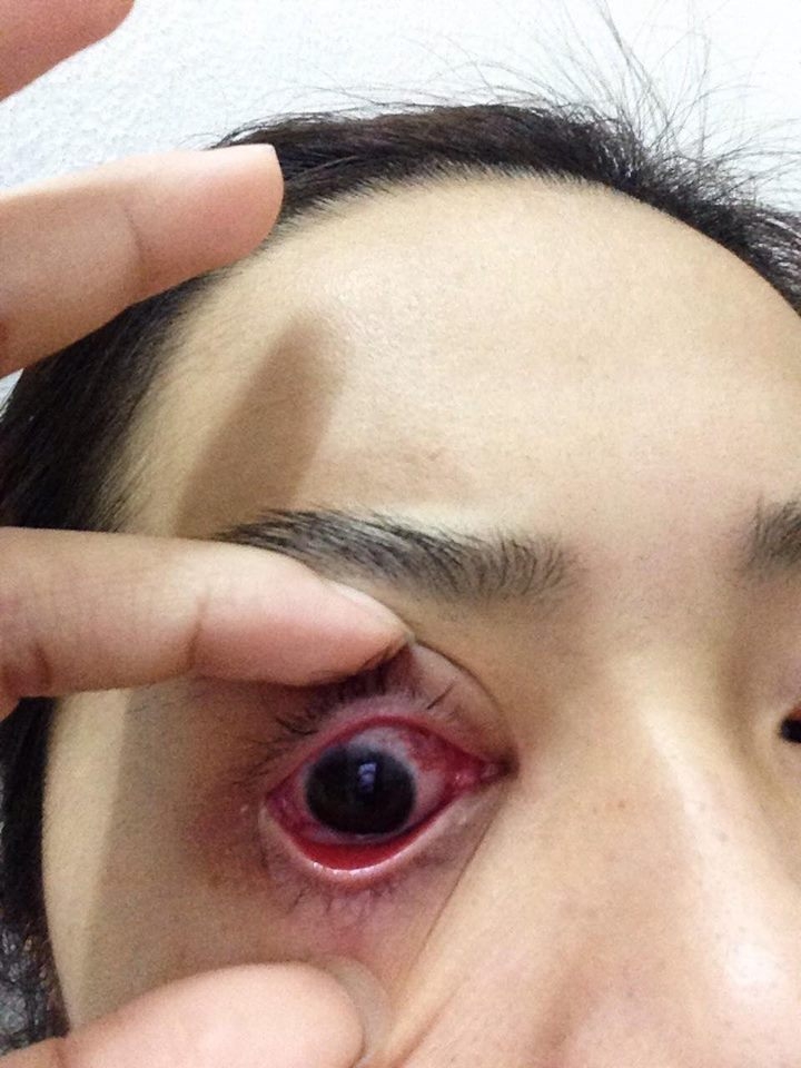 co gai tre bi mau tu trong mat sau 2 tuan noi mi
