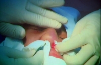 9 diem quan trong ban can biet truoc khi tiem botox