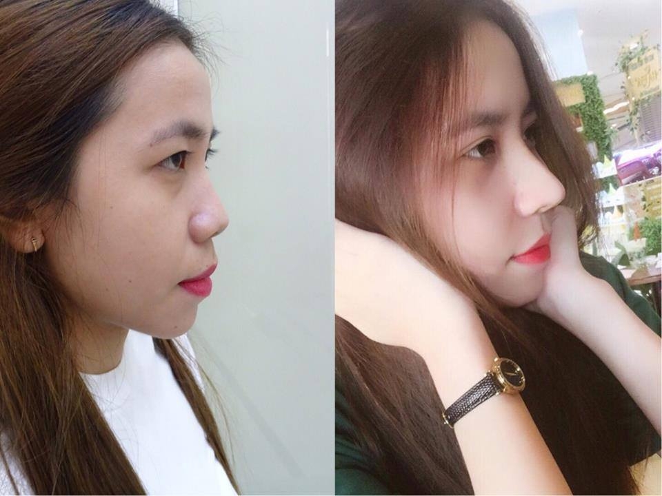 than thai vi dieu cua co gai 9x sau khi nhan mi nang mui s line