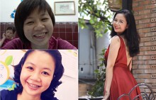 Niềng răng trong 6 năm liền, cô gái Sài Gòn nhận được thành quả mỹ mãn