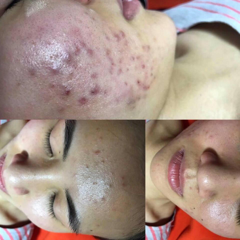 Kinh nghiệm trị mụn của 9X tự nhận mình có gương mặt ‘tra tấn thị giác người xem’ kinh nghiem tri mun cua 9x tu nhan minh co guong mat tra tan thi giac nguoi xem