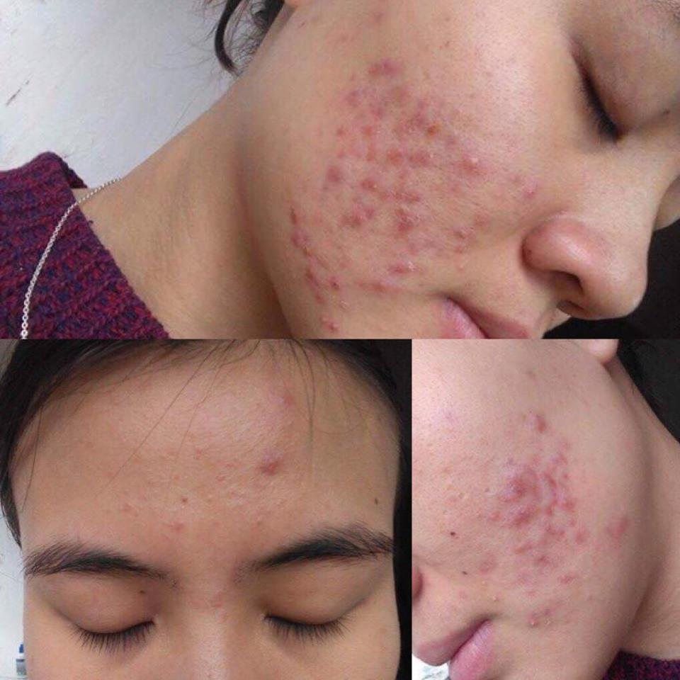 Kinh nghiệm trị mụn của 9X tự nhận mình có gương mặt ‘tra tấn thị giác người xem’ kinh nghiem tri mun cua 9x tu nhan minh co guong mat tra tan thi giac nguoi xem