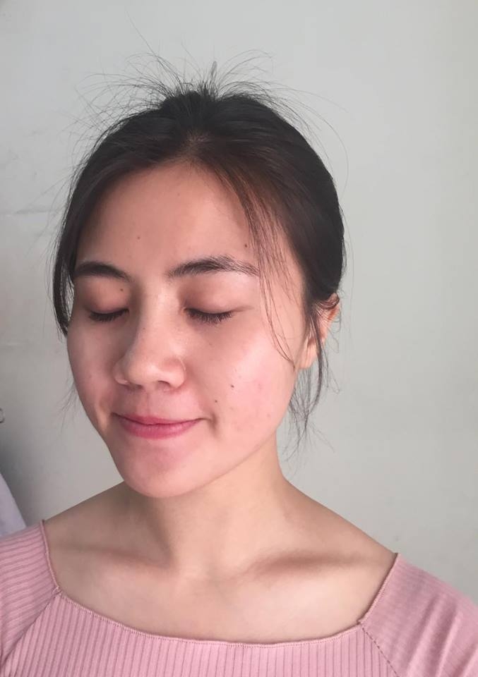Kinh nghiệm trị mụn của 9X tự nhận mình có gương mặt ‘tra tấn thị giác người xem’ kinh nghiem tri mun cua 9x tu nhan minh co guong mat tra tan thi giac nguoi xem