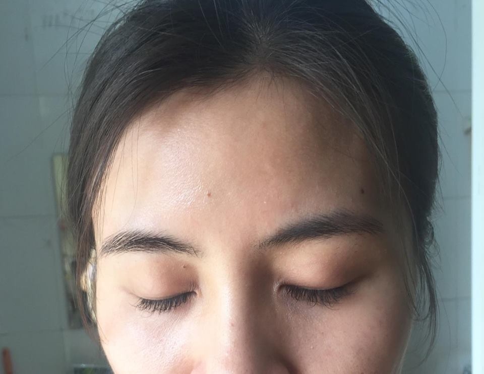 Kinh nghiệm trị mụn của 9X tự nhận mình có gương mặt ‘tra tấn thị giác người xem’ kinh nghiem tri mun cua 9x tu nhan minh co guong mat tra tan thi giac nguoi xem