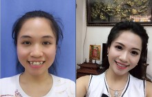 Diện mạo cô gái trẻ thay đổi chỉ sau 8 tháng niềng răng