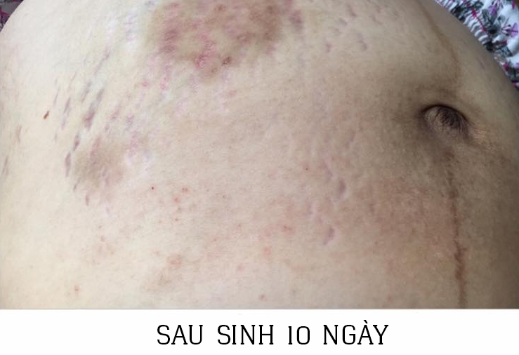 7 buoc lam dep sau sinh de thoat khoi canh bung beo nheo mo ran da sam den