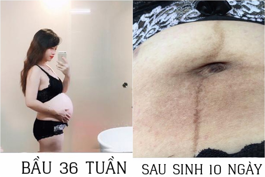 7 buoc lam dep sau sinh de thoat khoi canh bung beo nheo mo ran da sam den