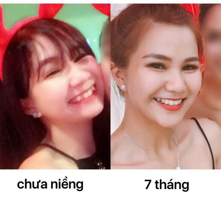 tung rang khap khenh mat tron co gai dinh nghi an don cam sua mui sau khi nieng rang