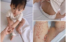 Ủ bệnh 10 ngày, bé trai 20 tháng được phát hiện mắc tay chân miệng nặng nhất bệnh viện