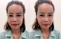 chup anh khong chinh sua co dau 62 tuoi lo lan da den sam sau phau thuat