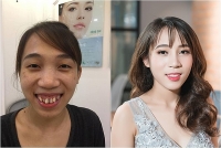 co gai xinh va tre hon chuc tuoi nho quyet tam phau thuat tham my